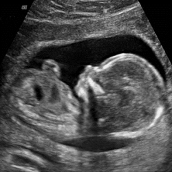 Obstetrical Ultrasound 3D/ 4D