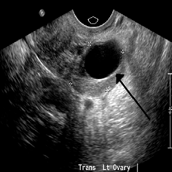 Gynecological Ultrasound